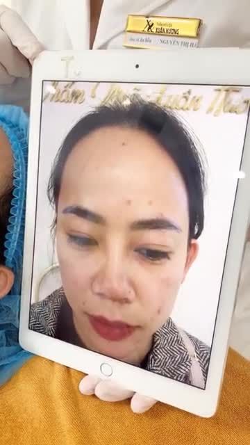 ''Chị đi hút mực mày nhiều nơi mà không thấy đỡ, đến Xuân Hương 1 buổi đã thấy hiệu quả''