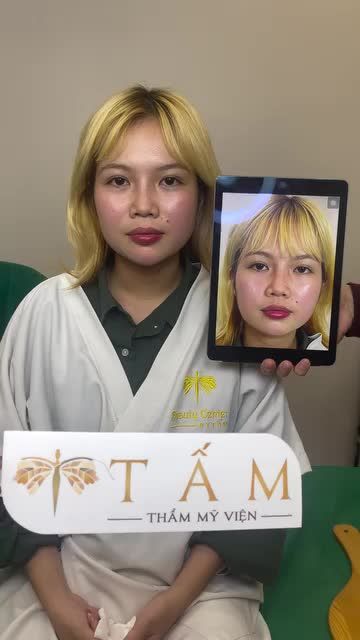 Ca Filler cằm tại phòng khám TMV Tấm.
