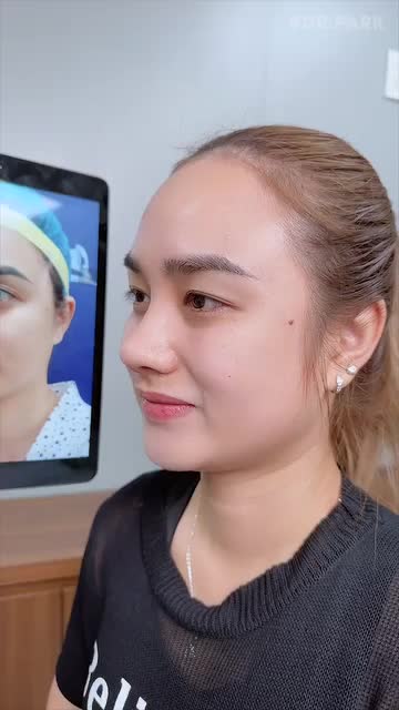 VÌ SAO NÂNG MŨI CẤU TRÚC PHÙ HỢP VỚI MỌI DÁNG MŨI?