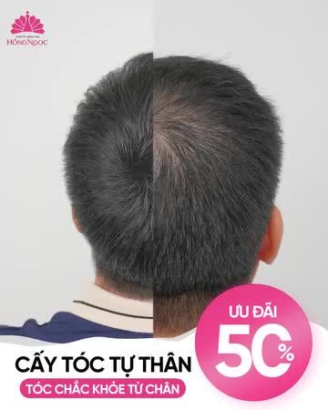 GẤP. CẦN TÌM KH HÓI ĐỈNH ĐẦU, HÓI CHỮ M, HÓI CHỮ U CẤY TÓC NHẬN ƯU ĐÃI