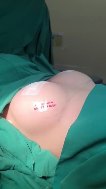 Bác sĩ Kỳ Y Dược vừa hoàn thành ca phẫu thuật nâng cấp V1 cho bạn khách có V1 teo lép bẩm sinh.