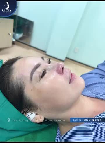 Hoàn thành ca nâng mũi cấu trúc có chỉnh nền xương mũi kết hợp cuộn cánh mũi cho chị khách đến từ Tây Ninh