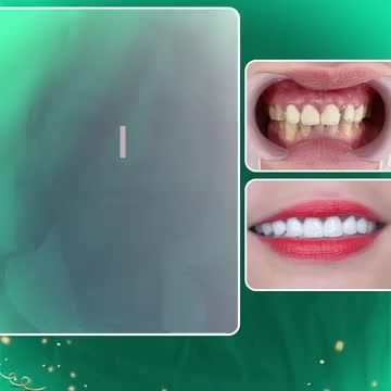 CẢM NHẬN CỦA KHÁCH HÀNG SAU HAI LẦN HẸN THẨM MỸ RĂNG SỨ TẠI NHA KHOA GIA ĐÌNH