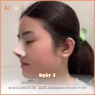 TẠI SAO ĐÂY LÀ THỜI ĐIỂM TỐT NHẤT ĐỂ NÂNG MŨI ĐÓN TẾT?