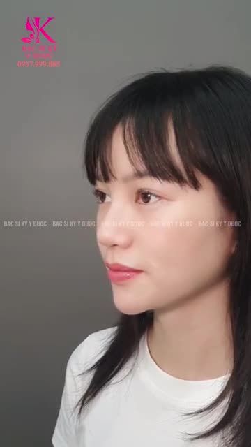 Khoe "nhẹ" với cả nhà hình ảnh xinh đẹp của bạn khách sau 2 năm Nâng Mũi do Bác sĩ Kỳ Y Dược thực hiện.