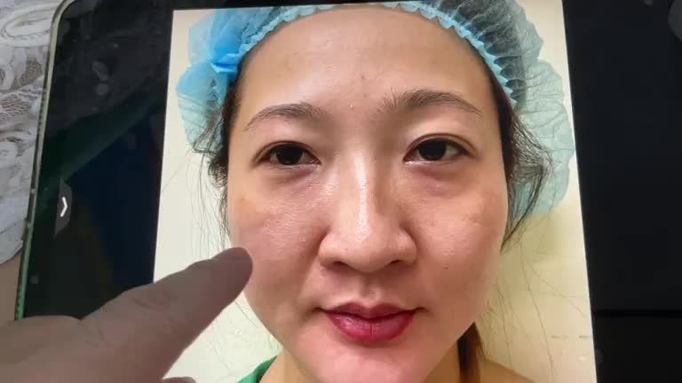 Căng da mặt không SẸO với Dr Vương Bạn gái từ Q6 đến khám lại sau 7 ngày hậu phẫu !