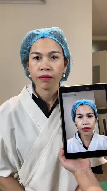 Cô Duyên được con gái giới thiệu đến Tấm sử dụng dịch vụ tiêm Filler để cải thiện những khuyết điểm trên khuôn mặt.