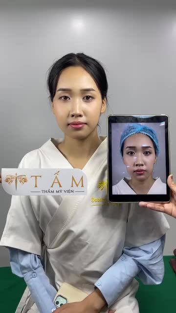 "Gương mặt em sau khi tiêm Filler xong trông trẻ hơn vài tuổi chị ạ" - đây là tâm sự của bạn Tuyết Anh sau khi sử dụng dịch vụ Filler má tại Tấm.