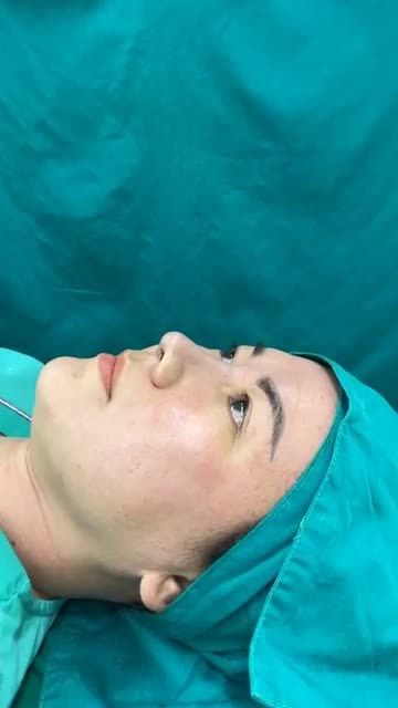 Case mũi cấu trúc surgiform vừa hoàn thành