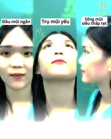 Với nền tảng  - Đầu mũi ngắn. - Trụ mũi yếu.  - Sống mũi siêu thấp tẹt = Phương pháp: nâng mũi cấu trúc Surgiform sẽ cho lên dáng mũi như thế nào.
