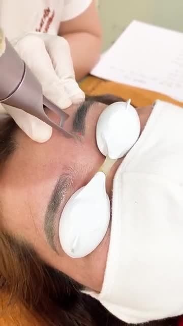 Mày trổ màu cỡ nào VTM Xuân Hương đều xử lý được nhờ các công nghệ laser hiện đại