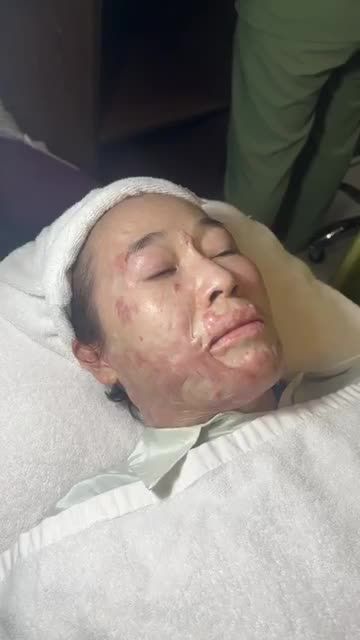 Quý cô người Đài bị SẸO BỎNG HẾT MẶT do tai nạn CẢI THIỆN ĐÁNG KỂ chỉ sau 4 buổi điều trị