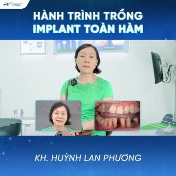 HÀNH TRÌNH TRỒNG IMPLANT TOÀN HÀM ALL-ON-4 - LẤY LẠI NỤ CƯỜI TỰ TIN