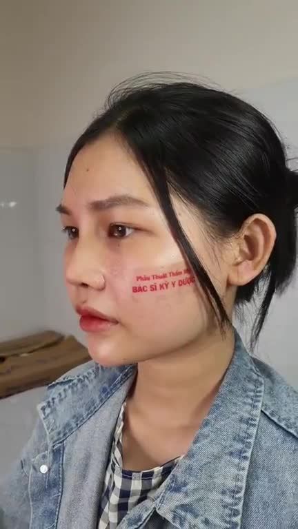 NÂNG MŨI ALINE BÁN CẤU TRÚC 2 LỚP KẾT HỢP CUỘN CÁNH MŨI - DÁNG MŨI TỰ NHIÊN