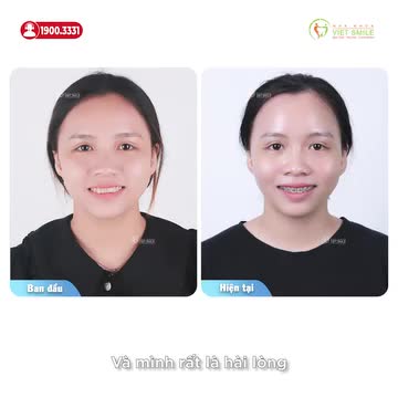 THAY ĐỔI TÍCH CỰC SAU HƠN 1 NĂM NIỀNG RĂNG HÔ, KHẤP KHỂNH