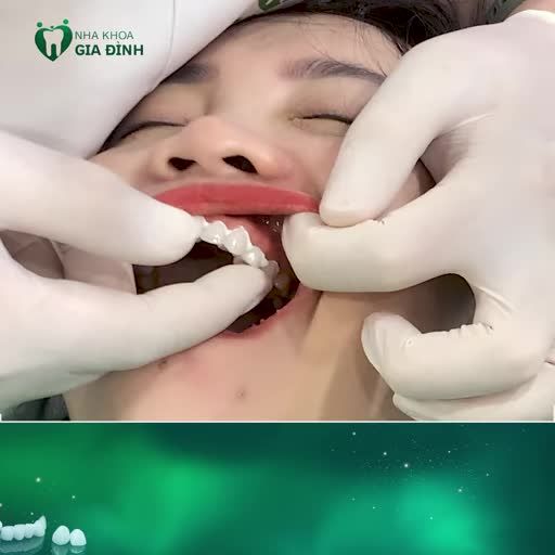LÀM RĂNG TẶNG RĂNG – DUY NHẤT THÁNG 9 NÀY CHỈ CÓ TẠI NHA KHOA GIA ĐÌNH