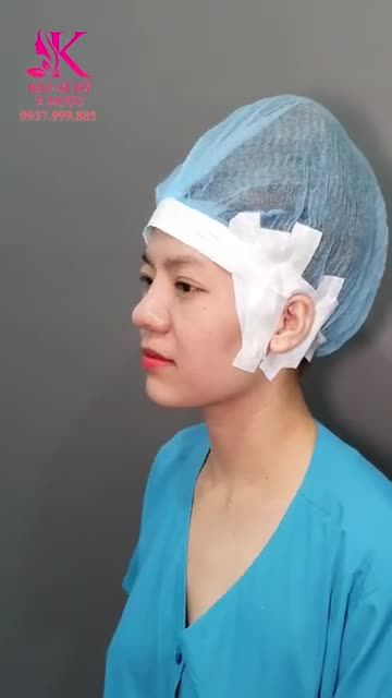 Sau 9 tháng phẫu thuật Nâng Mũi ALINE, chị khách đã thay đổi ngoạn mục.