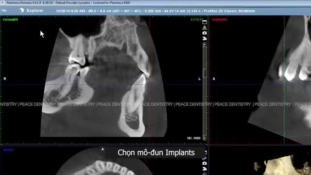 ĐẶT IMPLANT MÔ PHỎNG TRÊN PHẦN MỀM - Sự chính xác tối đa từ chẩn đoán, lập kế hoạch điều trị cho đến kết quả thực tế.