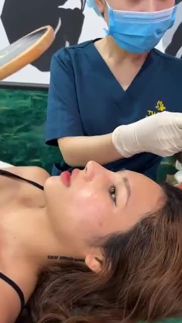Case mũi bọc sụn 10 ngày