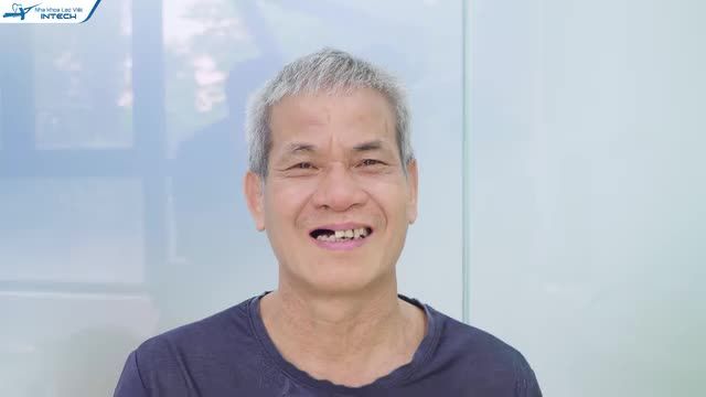 MẤT NỬA HÀM RĂNG KHẮC PHỤC NHƯ THẾ NÀO?