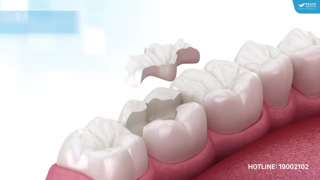  SÂU RĂNG VỚI LỖ SÂU LỚN, MẤT NHIỀU MÔ RĂNG