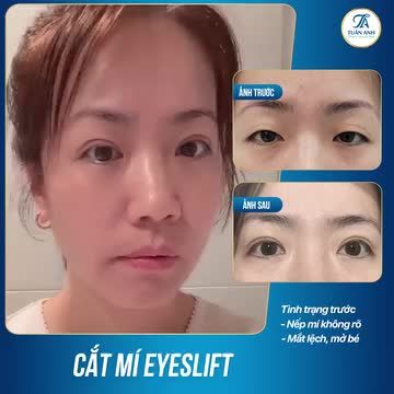 Feedback cắt mí sau 2 tuần