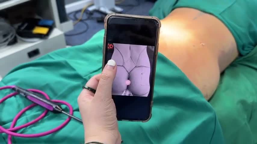 Khách hàng sau khi hút mỡ bụng, đã sử dụng mỡ tự thân đó để cấy vào hõm hông, tạo hình V3 siêu sexy.
