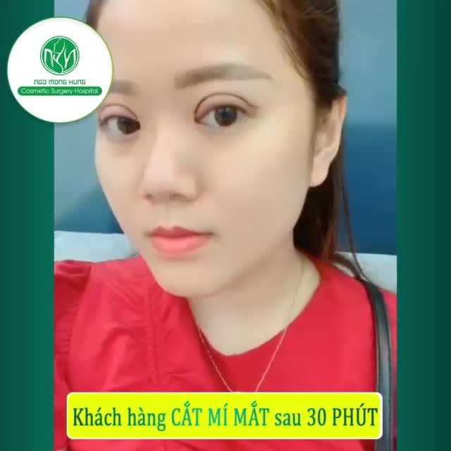 KHÁCH HÀNG CẮT MÍ MẮT BS. NGÔ MỘNG HÙNG SAU 30 PHÚT.