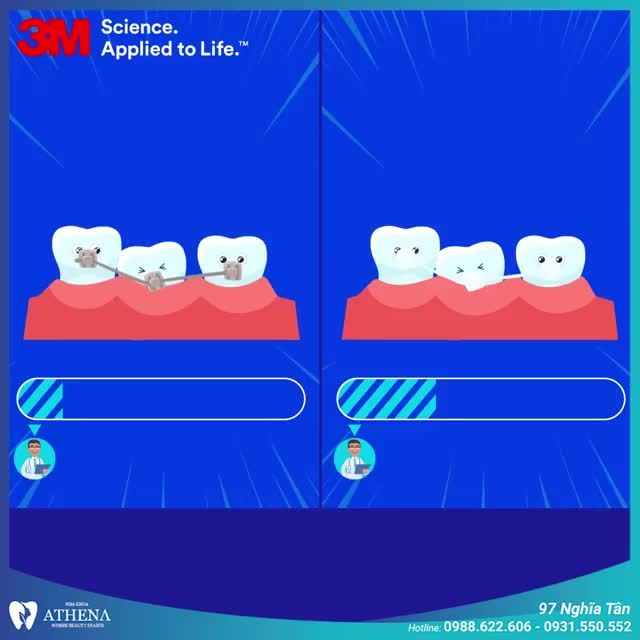 MẮC CÀI SỨ TỰ BUỘC - GIẢI PHÁP NIỀNG RĂNG CHO NGƯỜI SỢ ĐAU