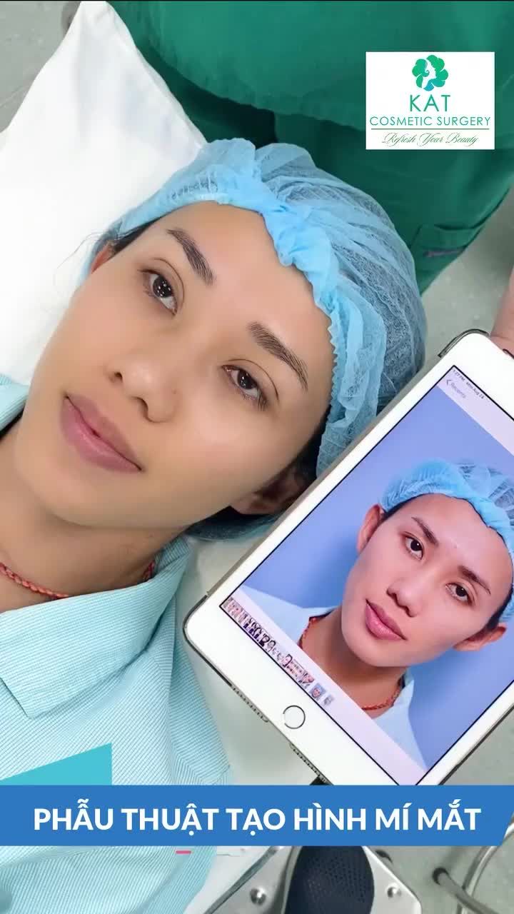 Mắt hai mí nhưng vẫn không đẹp