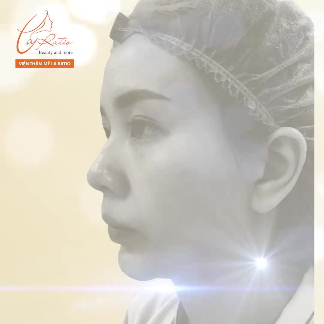 NÂNG MŨI MEGA S – KHẮC PHỤC MŨI GỒ - LỆCH