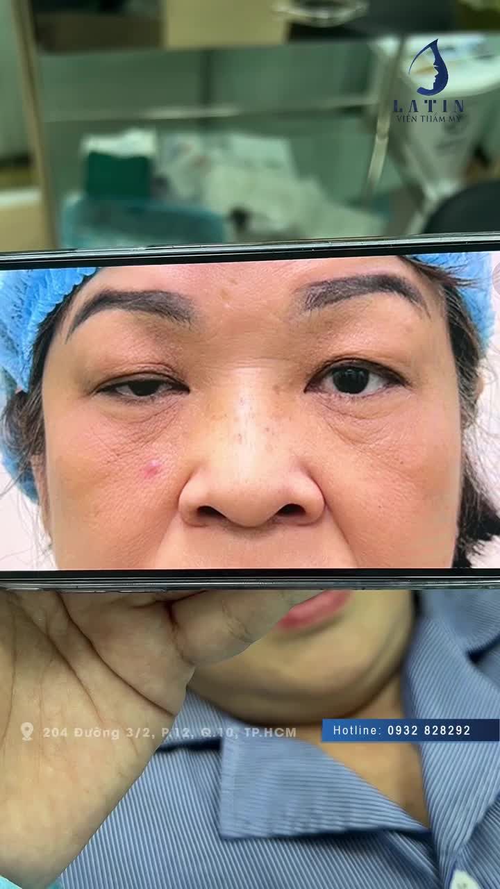 HOÀN THÀNH CA CẮT MÍ, CHỈNH NHƯỢC CƠ NÂNG MI BẨM SINH CHO CÔ KHÁCH U60