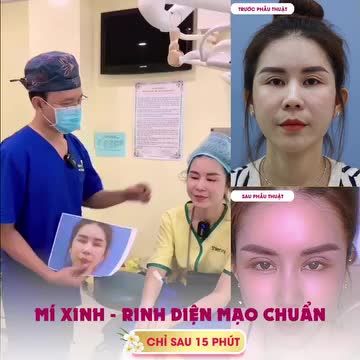 Khách hàng trước đó đã từng thực hiện dịch vụ nâng mũi 4s 1 lớp tại Thiện Mỹ, sau đó quay lại thực hiện thêm dịch vụ cắt mí mắt.