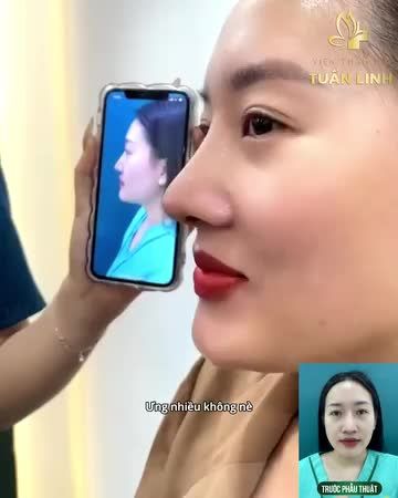 Khách hàng nói gì khi nâng mũi nhà Tuấn Linh