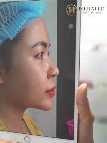 "Em mê quá dáng mũi bên Dr.Hải Lê Sài Gòn mà em tích tiền 6 tháng nay để sở hữu dáng mũi Demi Tech 6D làm mưa làm gió thời gian qua đây cả nhà ạ "