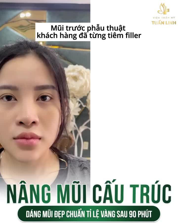 Nên tiêm filler mũi hay phẫu thuật nâng mũi = Xem ngay sự khác biệt ở clip bên dưới nha!