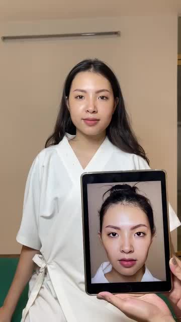 Bạn khách Ngọc Bích gặp tình trạng má hóp khiến khuôn mặt hốc hác trông vô cùng thiếu sức sống. Sau khi được tư vấn và sử dụng Filler má tại TMV Tấm, khuôn mặt bạn đã trở nên bầu bĩnh, cân đối hơn.
