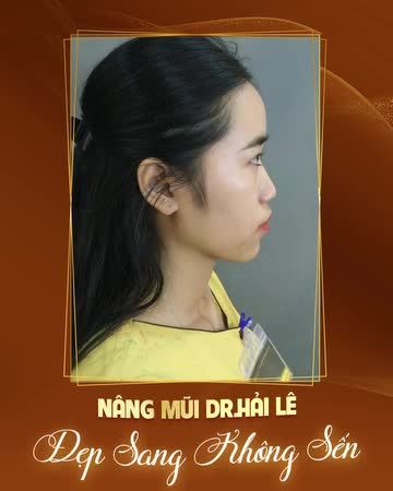 Mũi đẹp xinh, diện mạo cứ thế mà lung linh - Dáng mũi cực sáng khiến ai cũng phải "ngó ngàng".