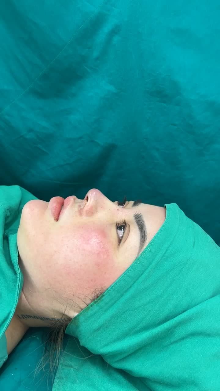 Case mũi cấu trúc vừa hoàn thành