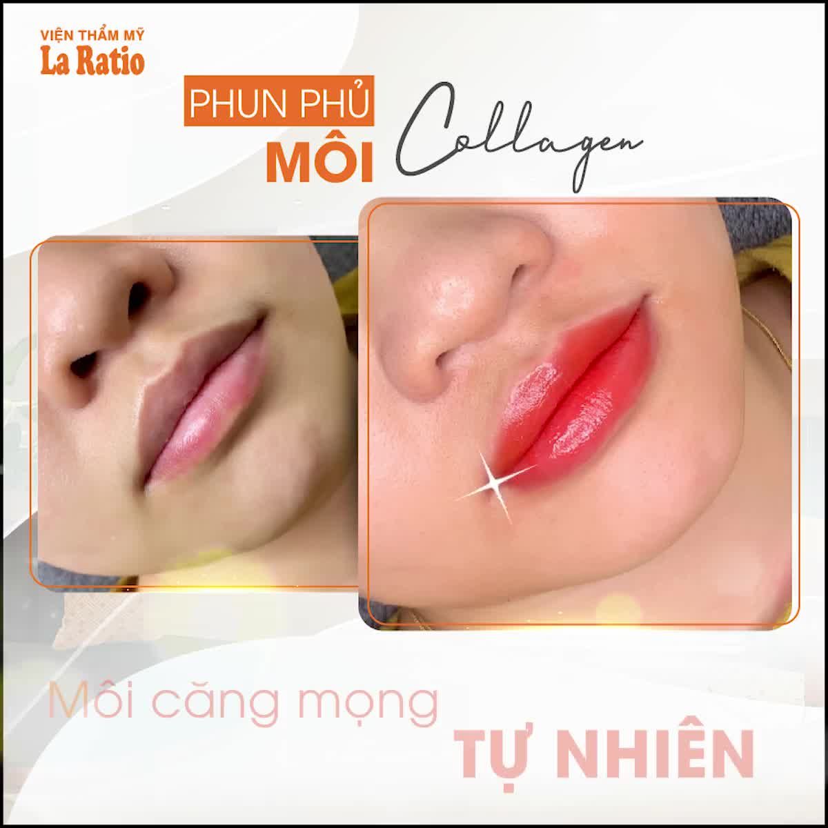 PHUN MÔI PHỦ COLLAGEN  MÔI CĂNG MỌNG TỰ NHIÊN – CHUẨN AN TOÀN