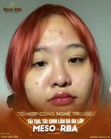 Muốn da khỏe đẹp từ gốc, chọn Meso-RBA Dr.Hải Lê!