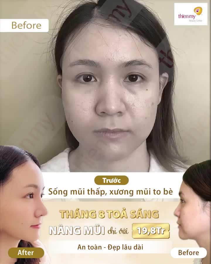 DÁNG MŨI SANG – CUỘC ĐỜI SÁNG  Nâng mũi chỉ với 19,8tr