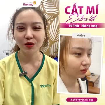 CẮT MÍ EXTRA LIFT – BÍ QUYẾT CHO ĐÔI MẮT TO TRÒN