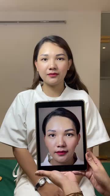 Chị khách bị hõm thái dương và phần má hóp diện rộng khiến khuôn mặt bị già trước tuổi. Giải pháp mà chị khách lựa chọn là combo trẻ hoá khuôn mặt tại Tấm.
