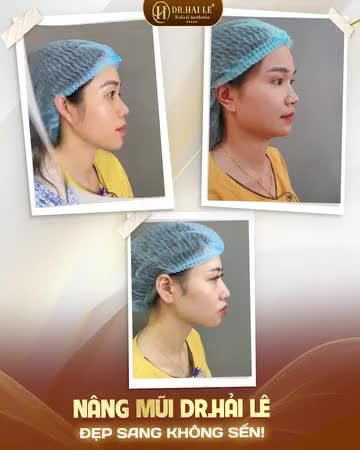 Chỉ 60 PHÚT dáng mũi của bạn đã hoàn toàn thay đổi, sống mũi cao tự nhiên, đầu mũi bay, cánh mũi nhỏ gọn, tinh tế.