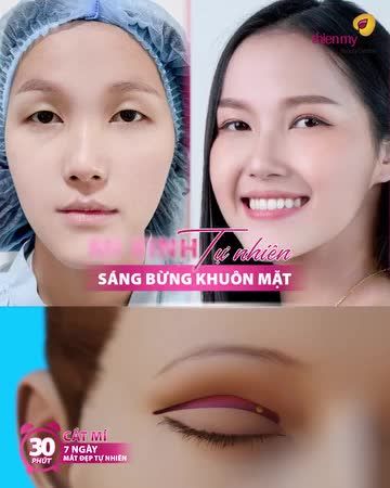 ĐÂY LÀ LÝ DO KH CHỌN THIỆN MỸ ĐỂ THỰC HIỆN DỊCH VỤ CẮT MÍ