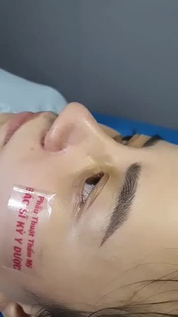 NÂNG MŨI ALINE - TẠO ĐIỂM NHẤN CHO KHUÔN MẶT BẠN