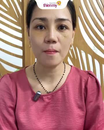 Nữ khách hàng chia sẻ cảm nhận sau 1 tháng thực hiện nâng mũi bọc sụn tại Thiện Mỹ