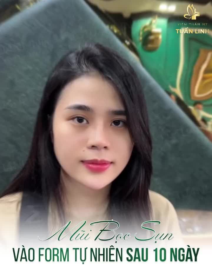 Mũi bọc sụn - Đẹp tự nhiên sau 10 ngày tháo nẹp Click xem ngay