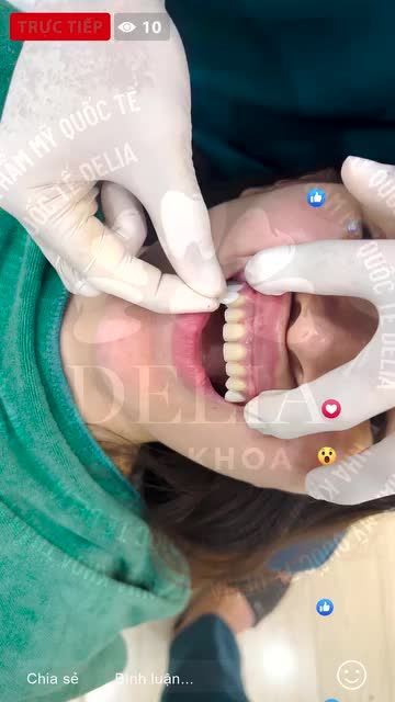 Bác sĩ lắp hoàn thiện 20 răng sứ Emax Press cho khách hàng